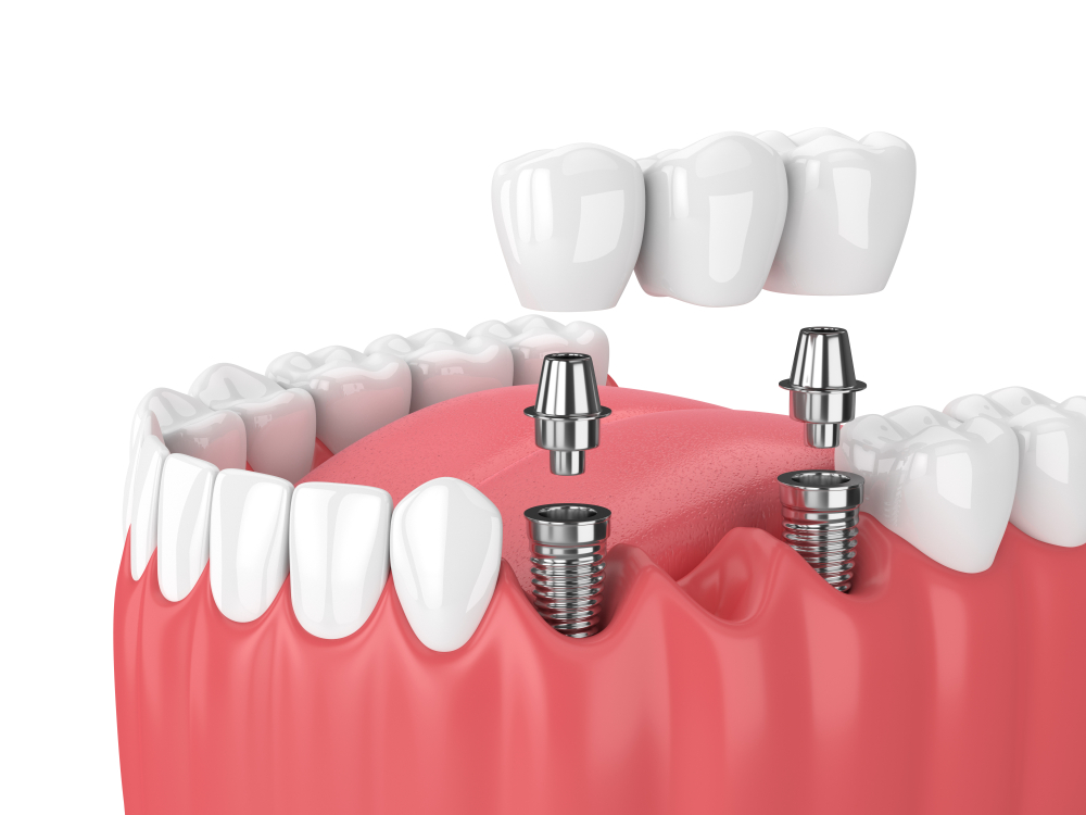 What are the Pros and Cons of Undergoing Dental Tooth Filling? - Elite  Dental Care